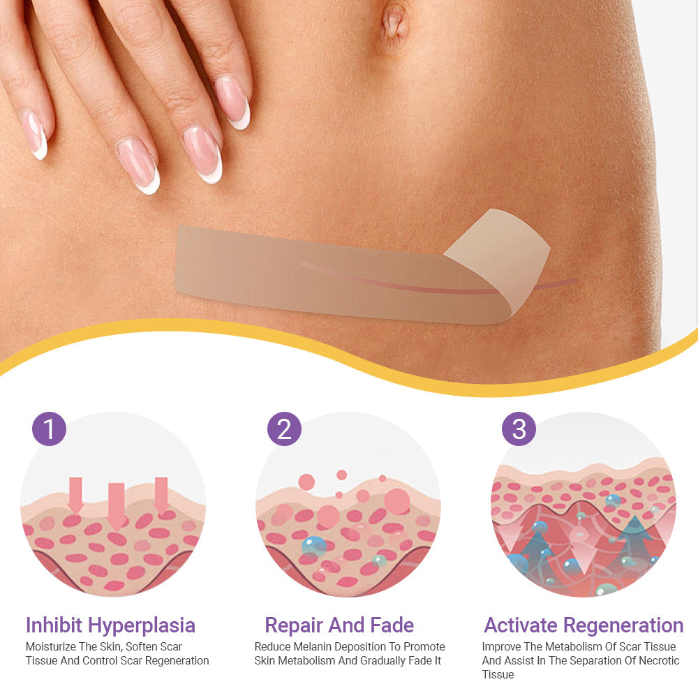 ✅ TGA Approved | Ourlyard® Hyaluronic Acid Nano Microneedle Repair Tape🦘🍀 (Effective in fading various types of scars, including surgical scars, burn scars, acne scars, and stretch marks, while improving uneven skin tone and skin imperfections.)